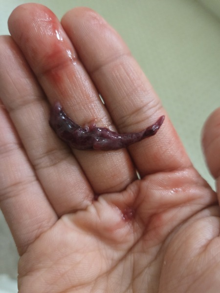 Is this a miscarriage or clot(GRAPHIC PIC)