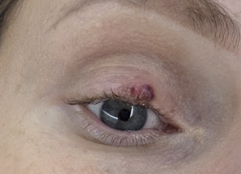 Large stye - how to encourage it to pop/reduce?