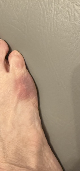Hurt foot or bunion?