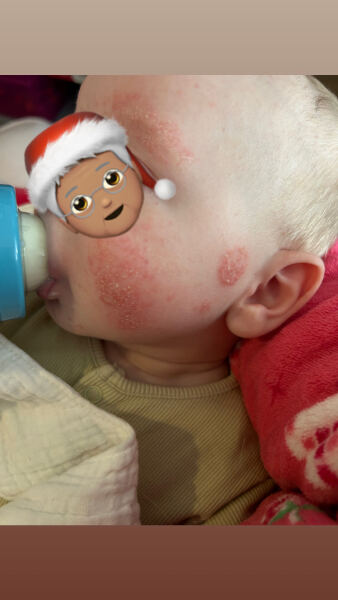 Baby eczema out of control.. recommendations?!