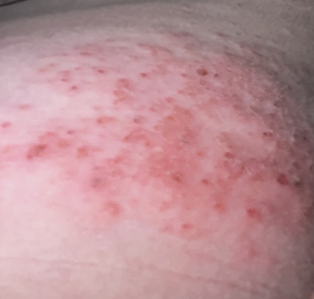 Shingles?
