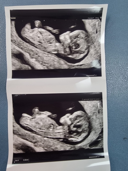 12w 6 days 🩷💙