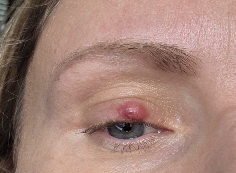 Large stye - how to encourage it to pop/reduce?