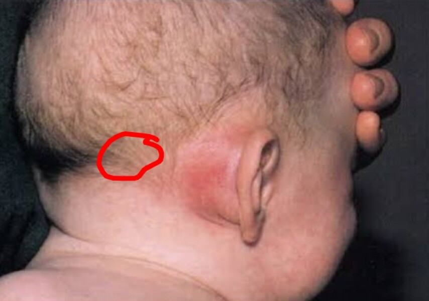 Bony lump on 10 month old baby's skull