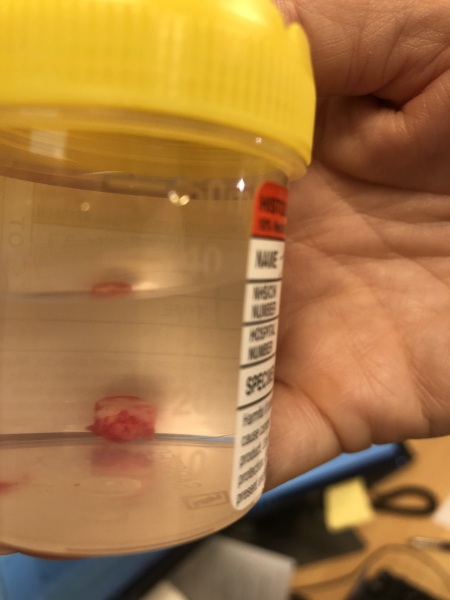 The best thing your body has produced *warning-grim content not suitable for weak-stomached persons*