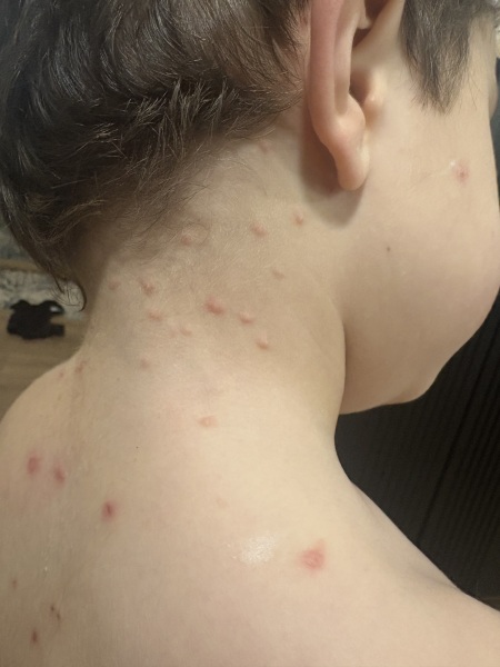 Persistent Spots/Rash