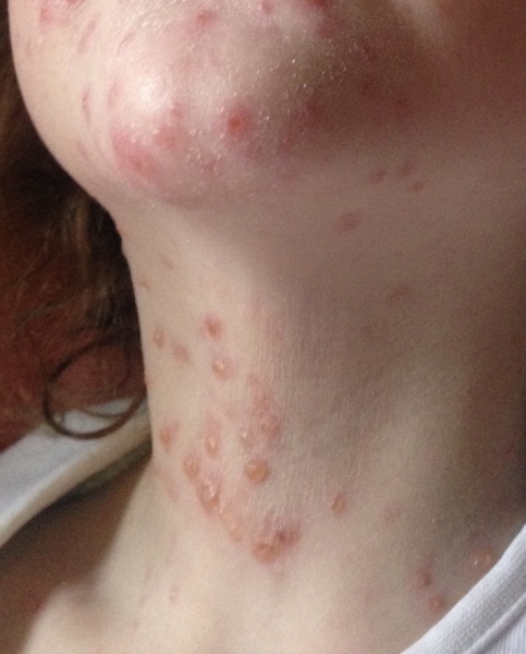 Chicken Pox or Not?