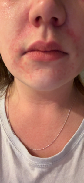 Perioral dermatitis