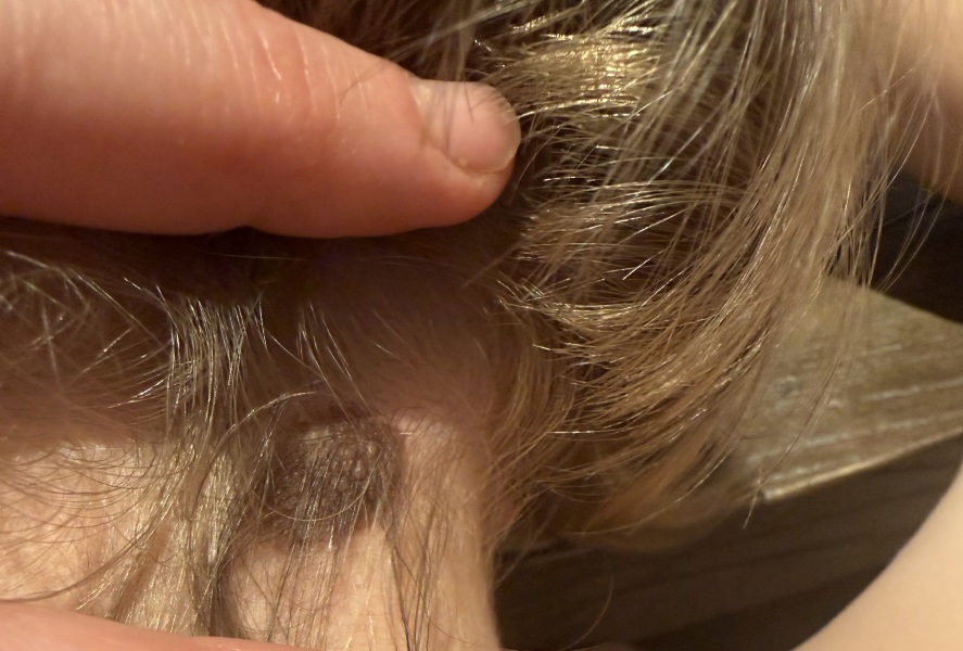 Mole/Birthmark changes