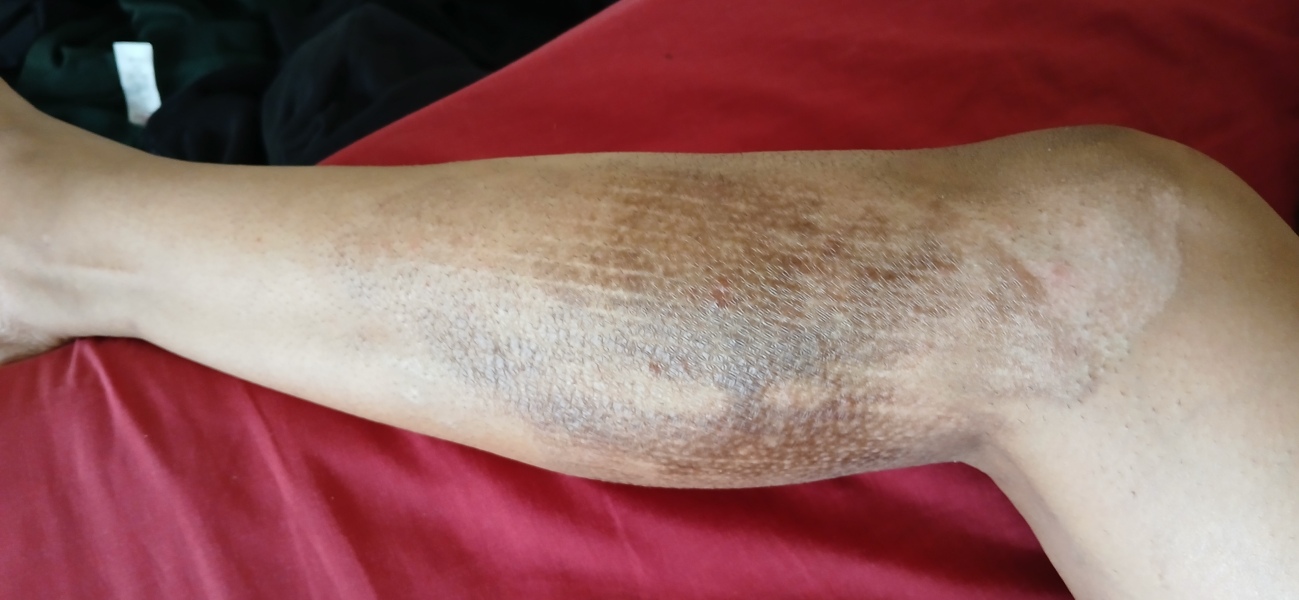2nd degree burns from boiling water