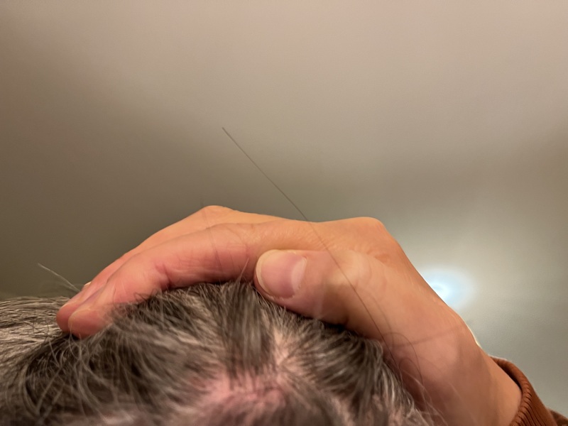 Any ideas what this sore red patch is on my scalp?