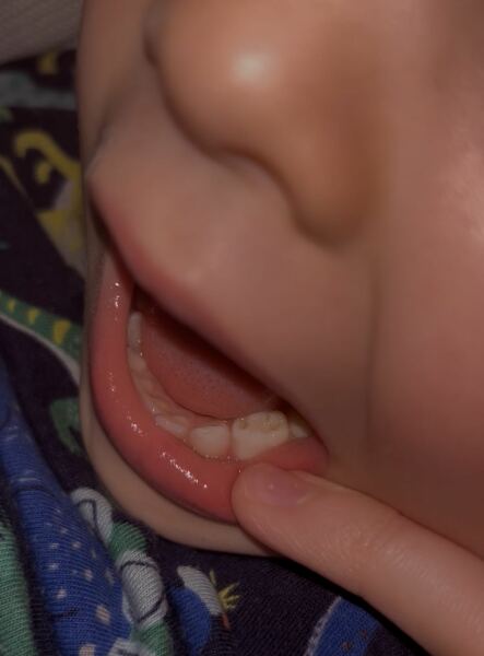 Toddler cavity?