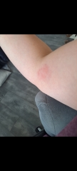 Does this look like shingles?