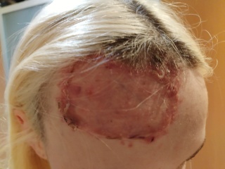 Daughter in hospital - full thickness burns