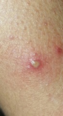 Infected chickenpox