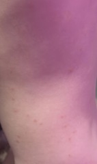 Chicken Pox or bites?