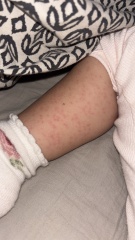 Does this look like Scarlett fever?