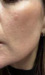 Has anyone had similar on their face. Is it skin cancer?