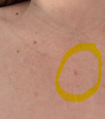 Mole - normal or get checked?