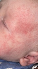 5 week old baby rash