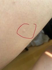 What are these round dots on my arms