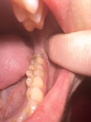 Horrible pic sorry teeth related