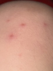 Possible Chickenpox’s