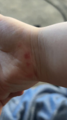 Is this Hand, Foot & Mouth?