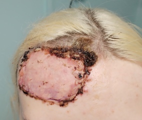Daughter in hospital - full thickness burns