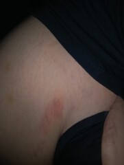 Help strange stretch mark bump underneath