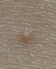 Possible Chickenpox’s