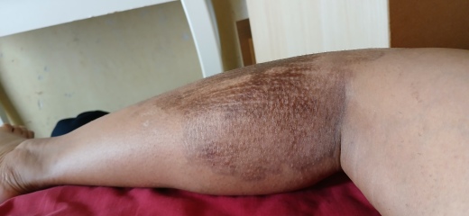 2nd degree burns from boiling water