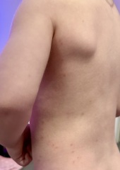 Chicken Pox or bites?