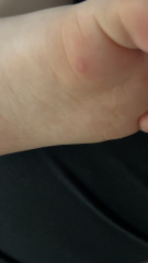 Is this Hand, Foot & Mouth?