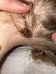 Mole/Birthmark changes