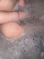 Chicken pox? (Pics attached)