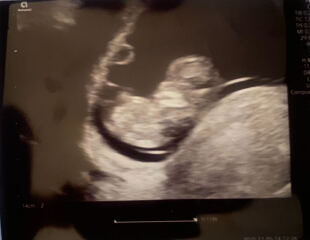 10 week scan, gender guess…