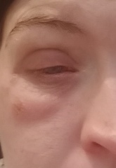 Eye problem