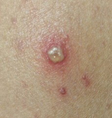 Infected chickenpox