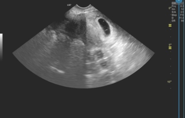 6 weeks and 5 days ultra sound scan and I’m scared it’s Blighted Ovum