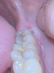Horrible pic sorry teeth related