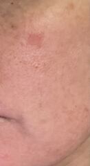 Has anyone had similar on their face. Is it skin cancer?