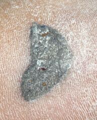 to ask for amateur dermatology help (extreme grossness warning)