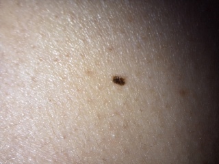 Help me to cope with the wait - a very bad feeling about a mole