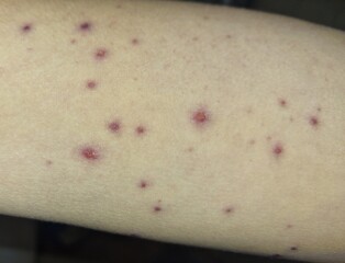 Infected chickenpox