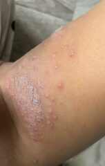 Do these chicken pox look normal ?