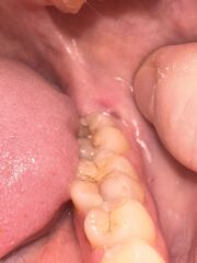 Horrible pic sorry teeth related
