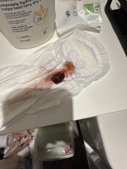 Blood clot 10 days after birth