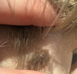 Mole/Birthmark changes