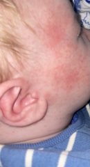 Newborn rash eczema or baby acne?